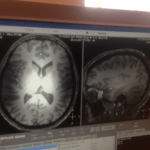 A picture of an MRI scan of my brain.