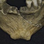 Mandible showing a cleft chin